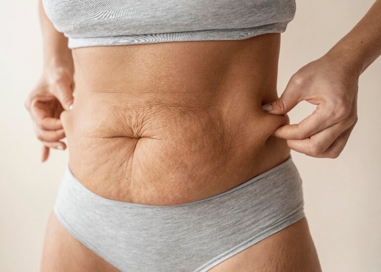 Excesso de pele após emagrecimento: por que acontece e quando a cirurgia deixa de ser estética para virar necessidade